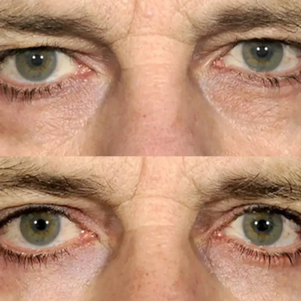 Oculoplastic Treatment