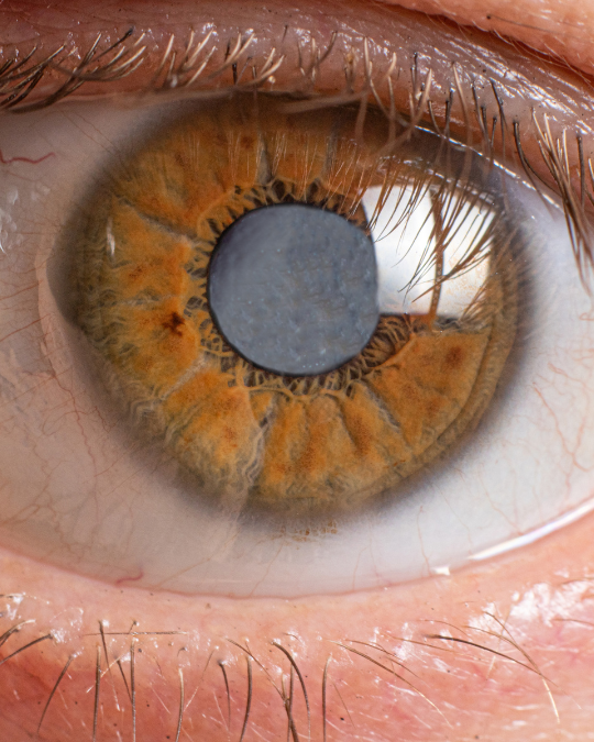 Best eye hospital in Dubai with expert ophthalmologists and advanced cataract services.