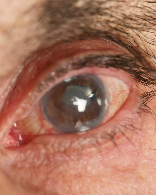 Best eye hospital in Dubai with expert ophthalmologists and advanced glaucoma services.