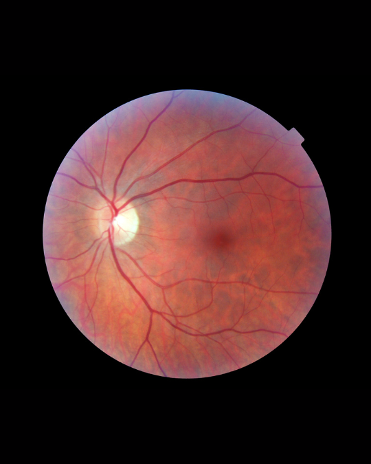 Best eye hospital in Dubai with expert ophthalmologists and advanced retina services.