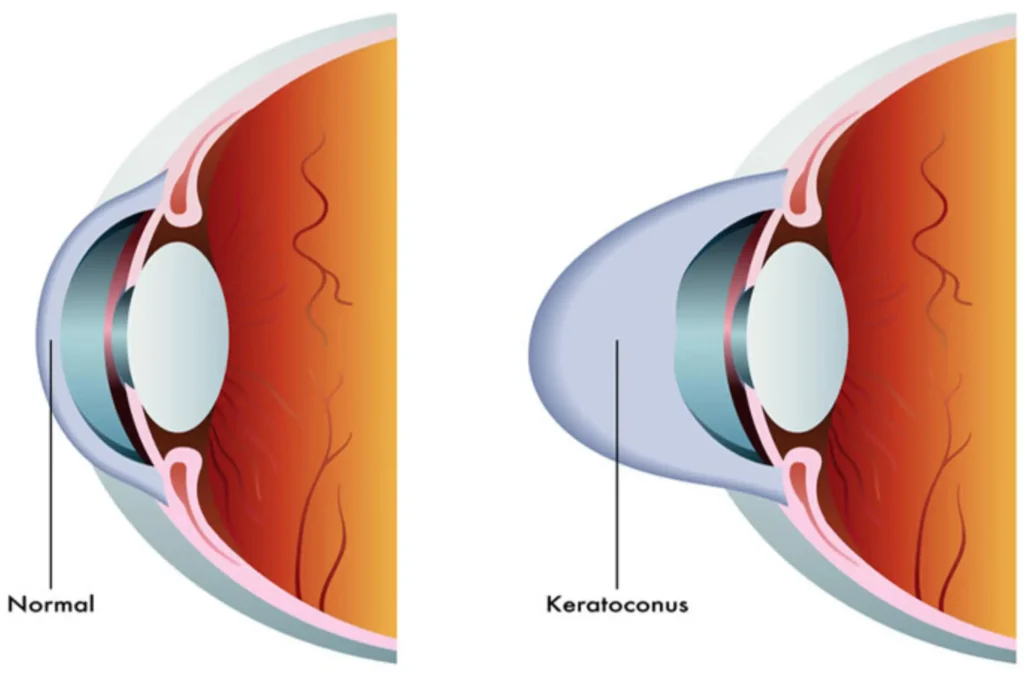 Cornea specialist in Dubai performing a detailed eye examination.