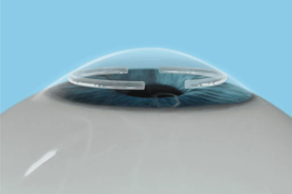 Cornea specialist in Dubai performing a detailed eye examination.