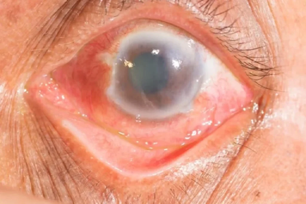 glaucoma Quironsalud