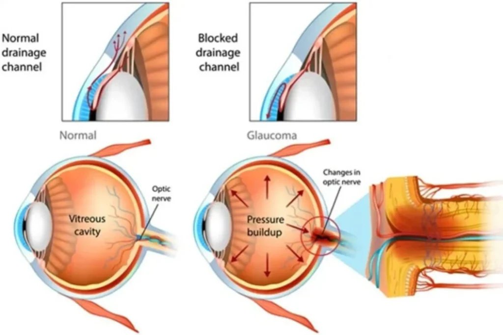 glaucoma Quironsalud