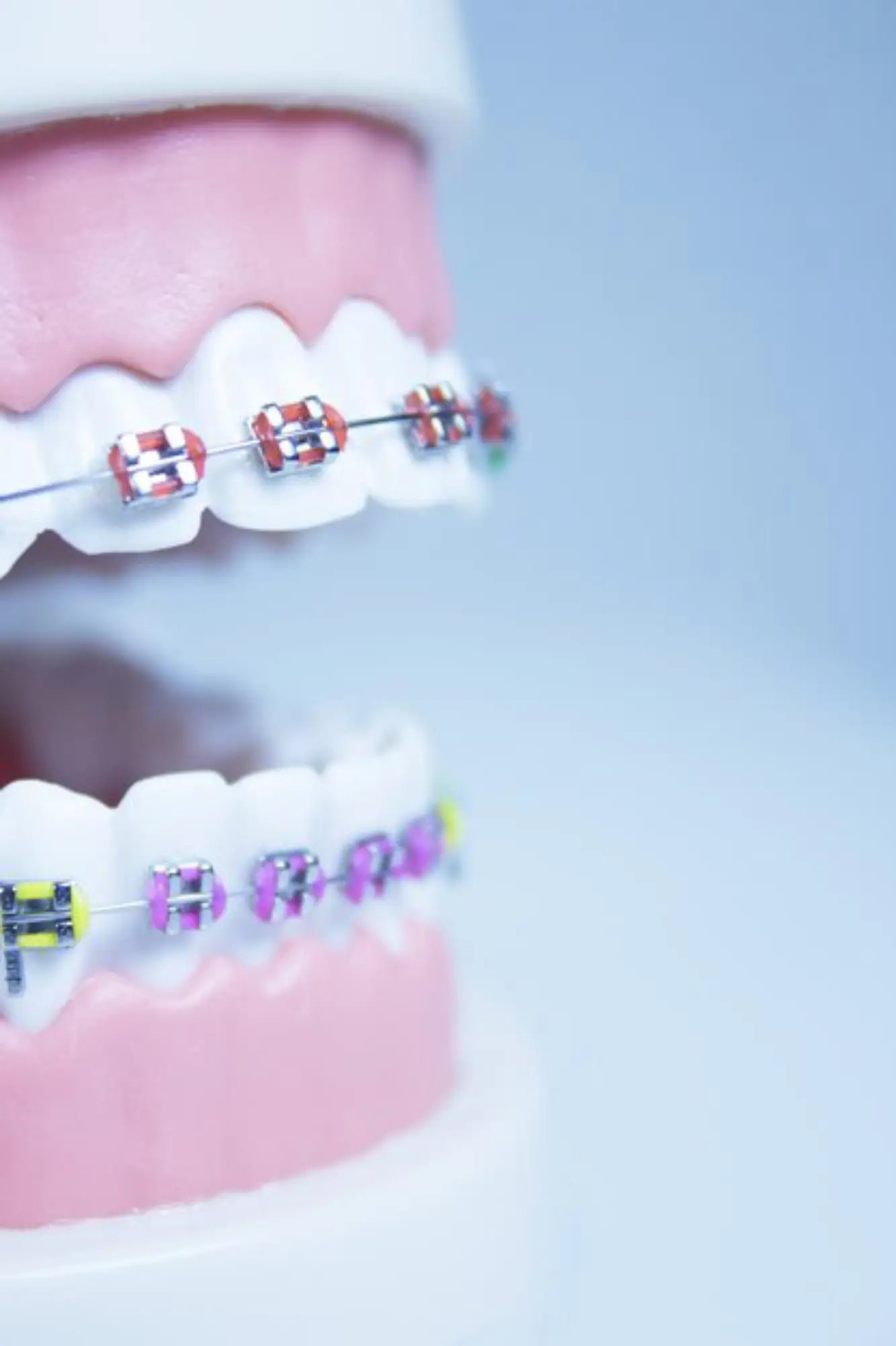Orthodontics provided by quironsalud dental clinic dubai offering expert quironsalud dental services and dental treatments quironsalud