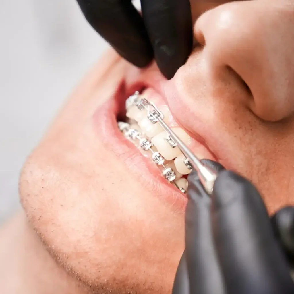 Orthodontic treatment dubai at our clinic with ceramic braces