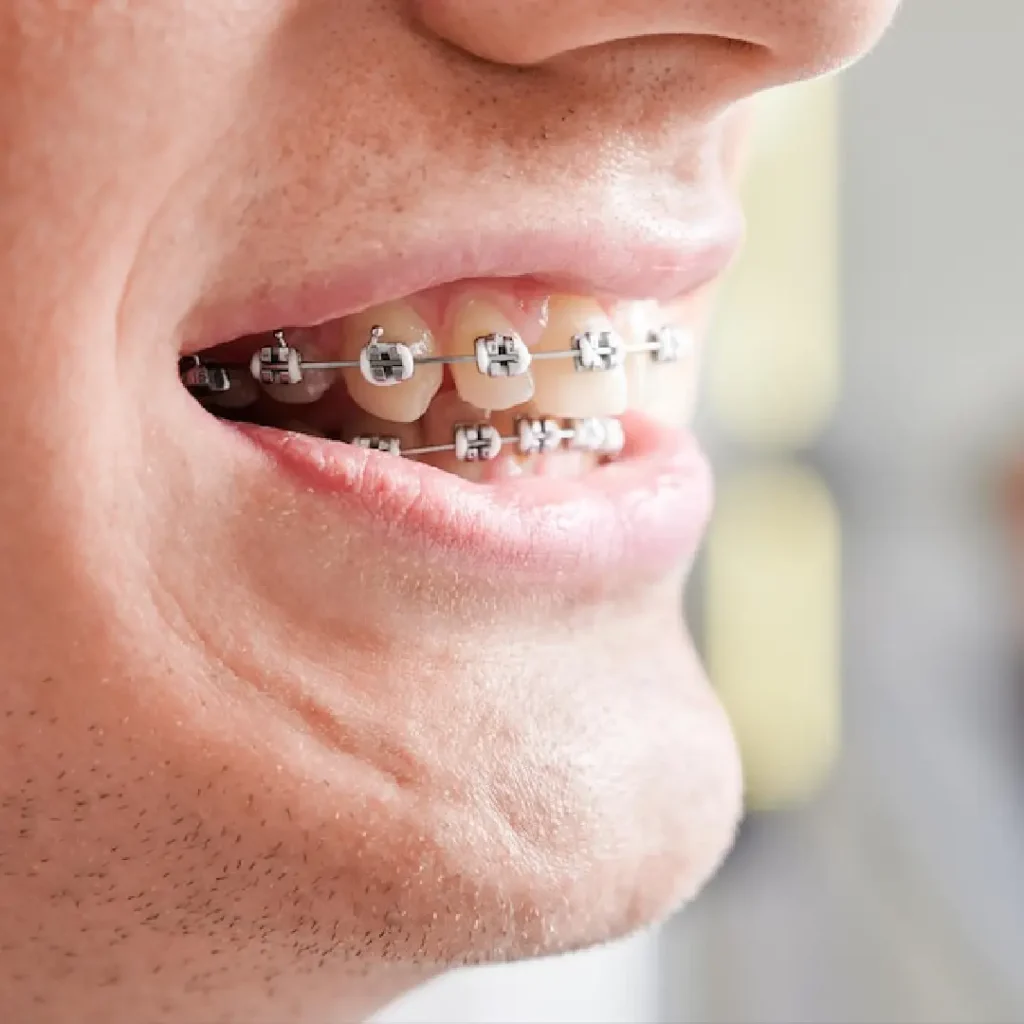 Orthodontic treatment dubai at our clinic with lingual braces