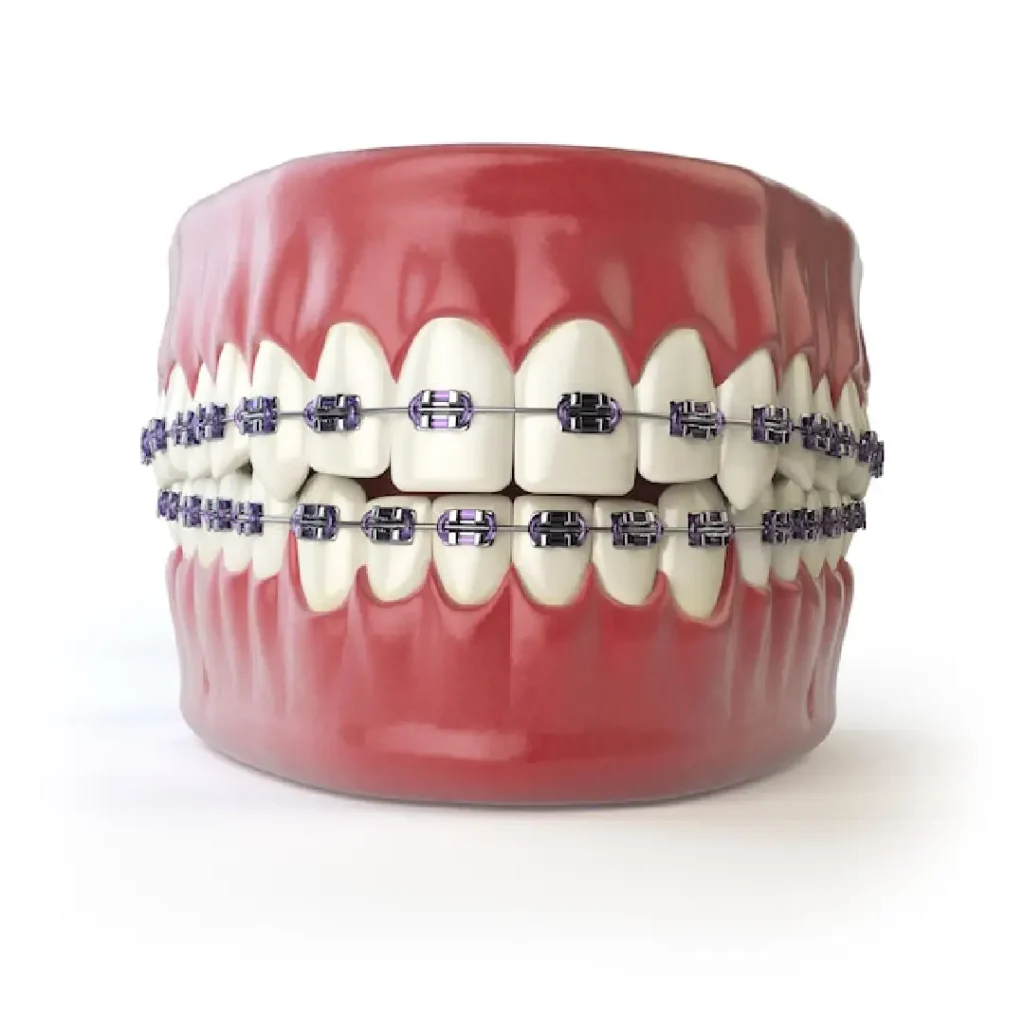 Orthodontic treatment dubai at our clinic with colored braces