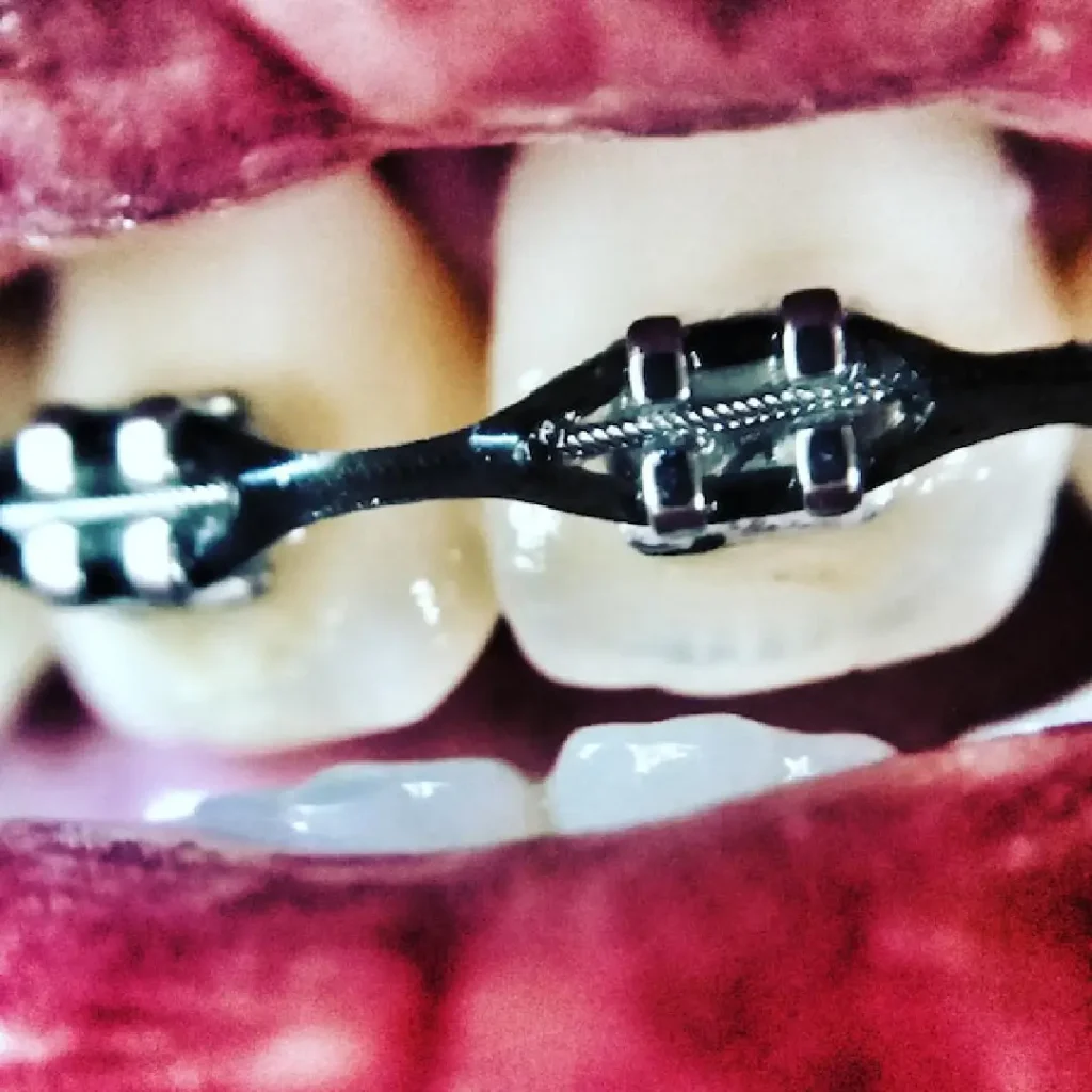 Orthodontic treatment dubai at our clinic with Damon braces