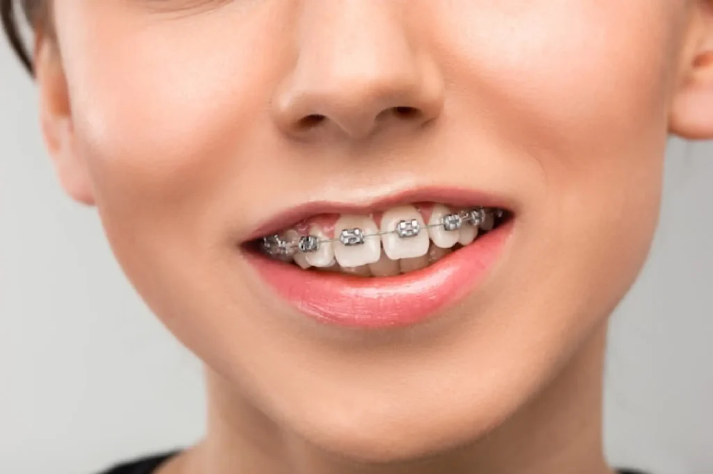 Braces for teens at Quirónsalud Hospital Dubai