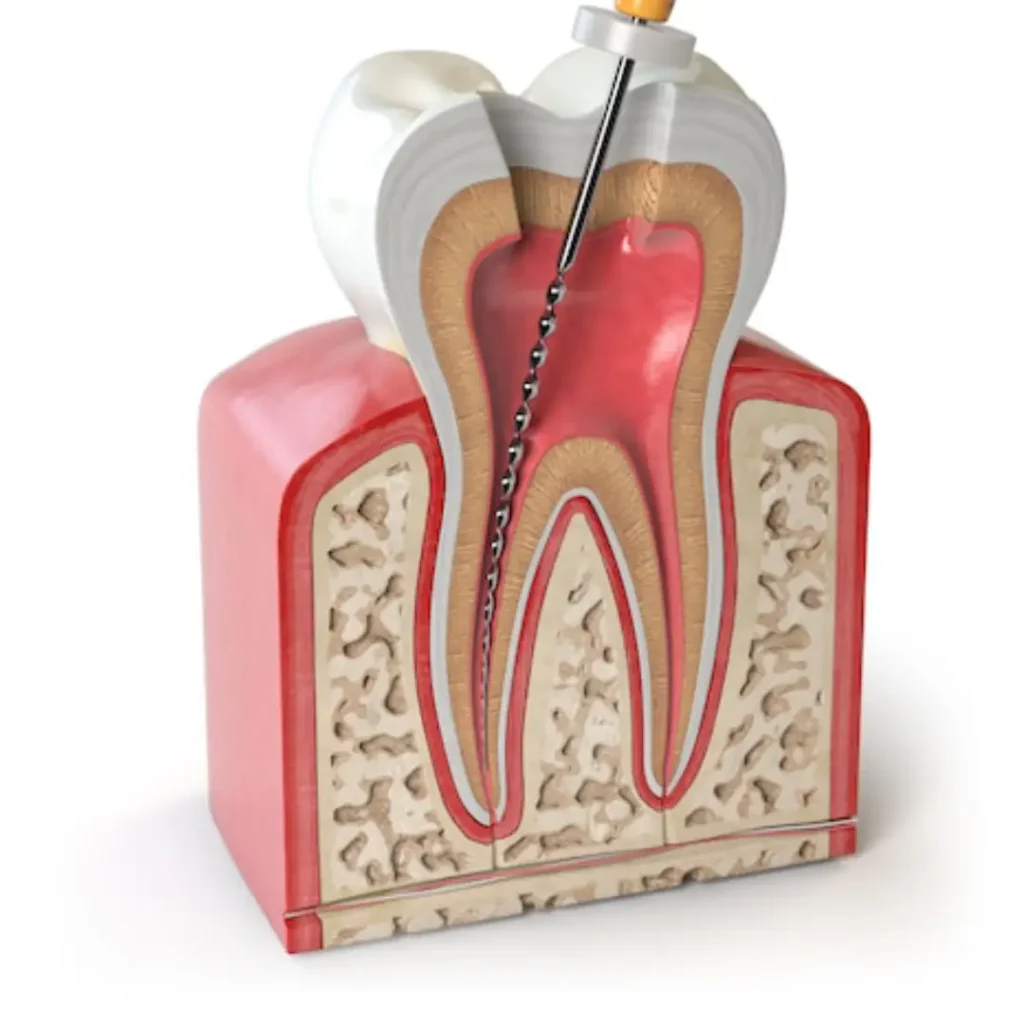 General dentistry root canal treatment in Dubai at Quirónsalud Specialty Hospital